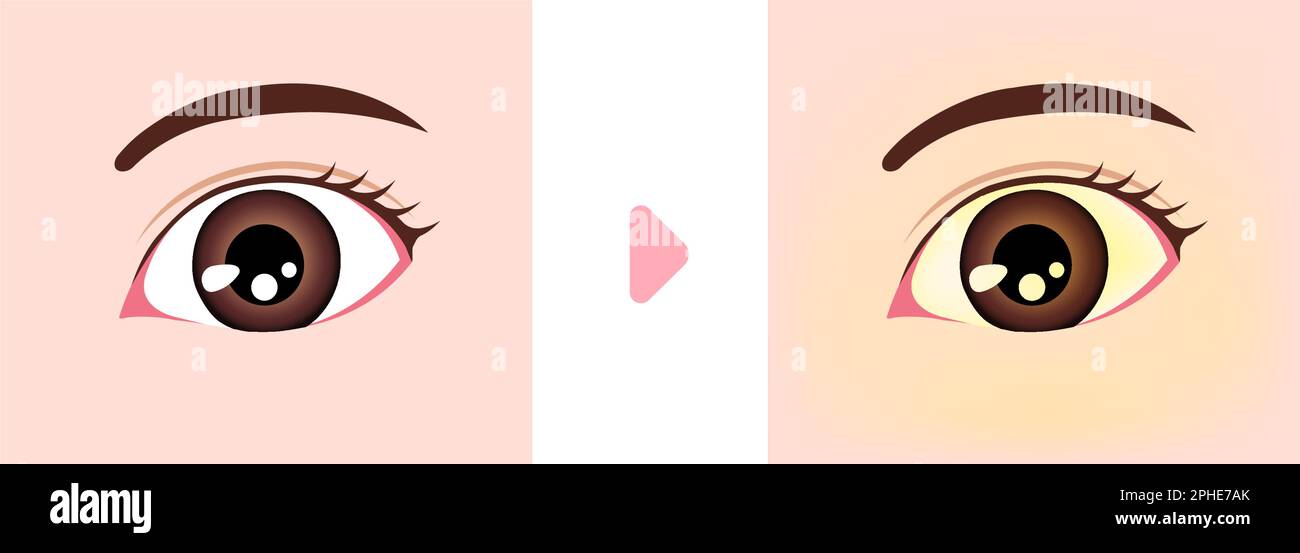 Illustration de comparaison des yeux normaux et jaundés Illustration de Vecteur