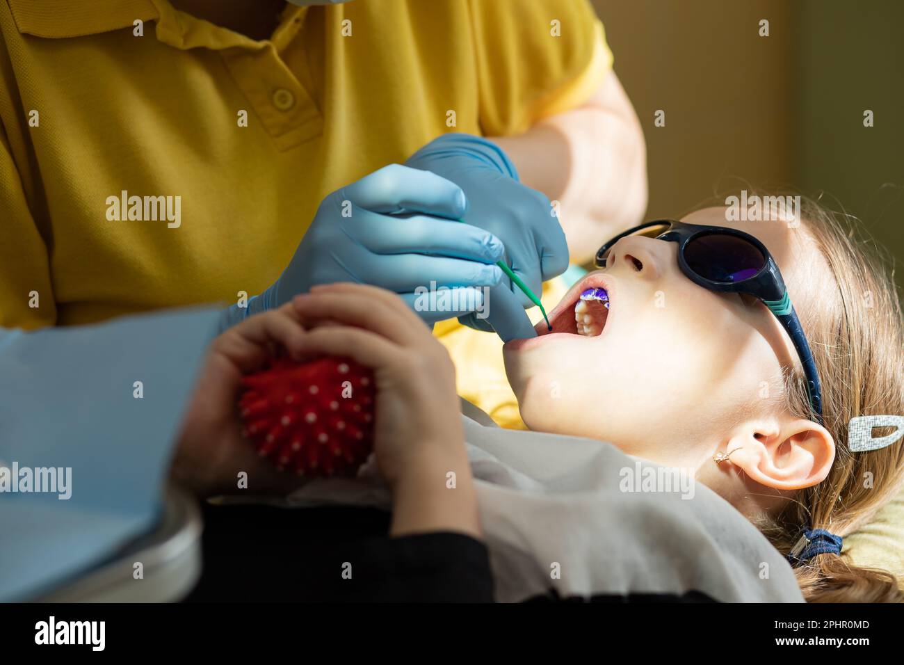 Plaque sur les dents de couleur rose et pourpre.bain de bouche pour bébé. Visite dentaire. Dents avant et après le brossage et le blanchiment en une seule photo. Préventif Banque D'Images
