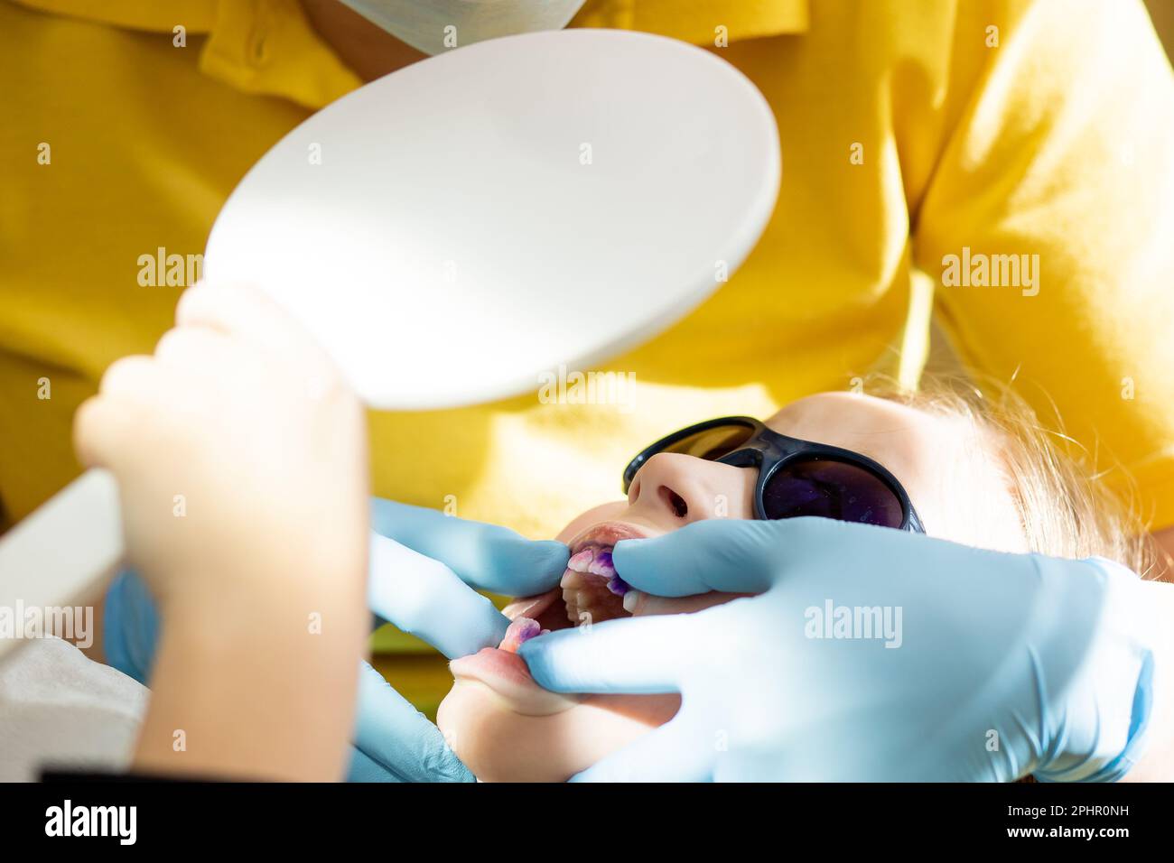 Plaque sur les dents de couleur rose et pourpre.bain de bouche pour bébé. Visite dentaire. Dents avant et après le brossage et le blanchiment en une seule photo. Préventif Banque D'Images