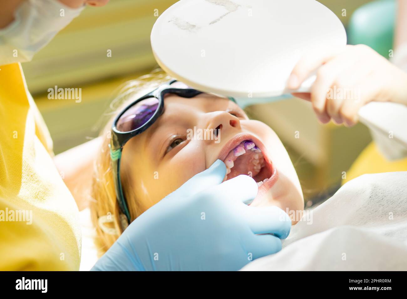 Plaque sur les dents de couleur rose et pourpre.bain de bouche pour bébé. Visite dentaire. Dents avant et après le brossage et le blanchiment en une seule photo. Préventif Banque D'Images