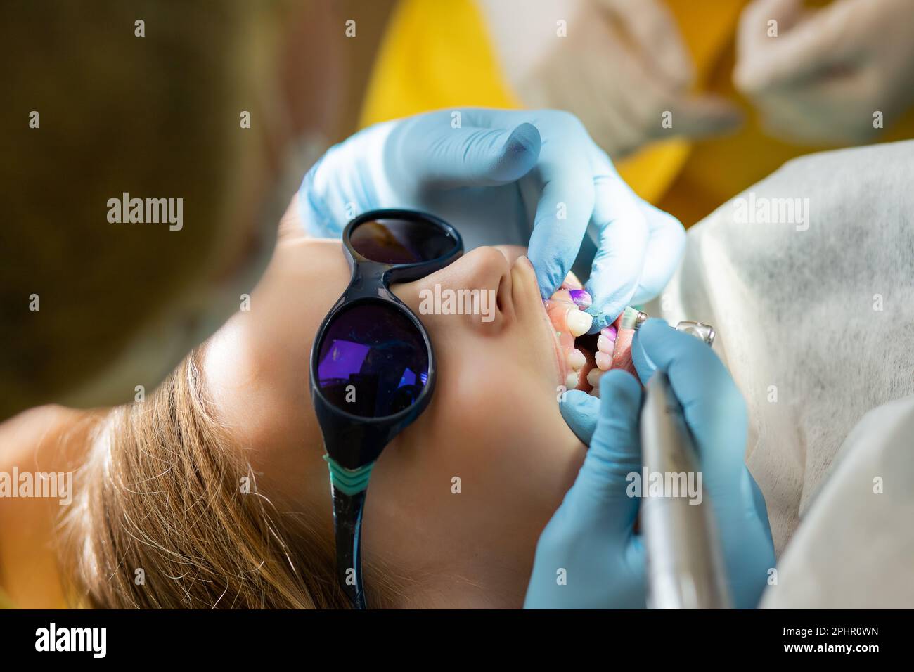 Plaque sur les dents de couleur rose et pourpre.bain de bouche pour bébé. Visite dentaire. Dents avant et après le brossage et le blanchiment en une seule photo. Préventif Banque D'Images