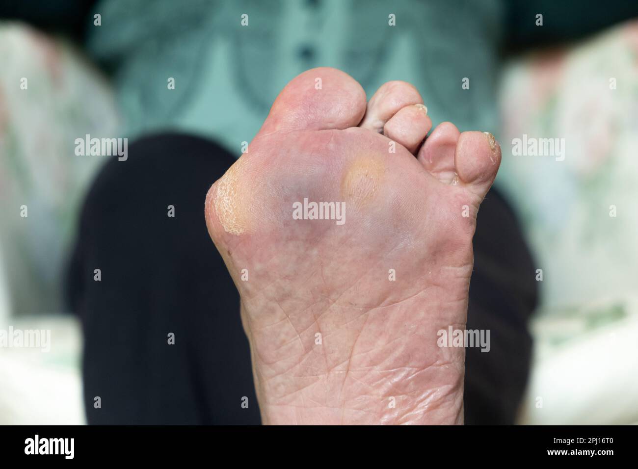 Un Boignon, également connu sous le nom d'hallux valgus, est une déformation de l'articulation reliant le gros orteil au pied Banque D'Images