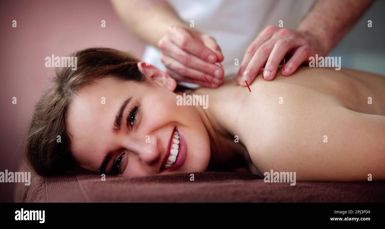 Traitement d'acupuncture à aiguille sèche. Thérapie Spa médicale féminine Banque D'Images