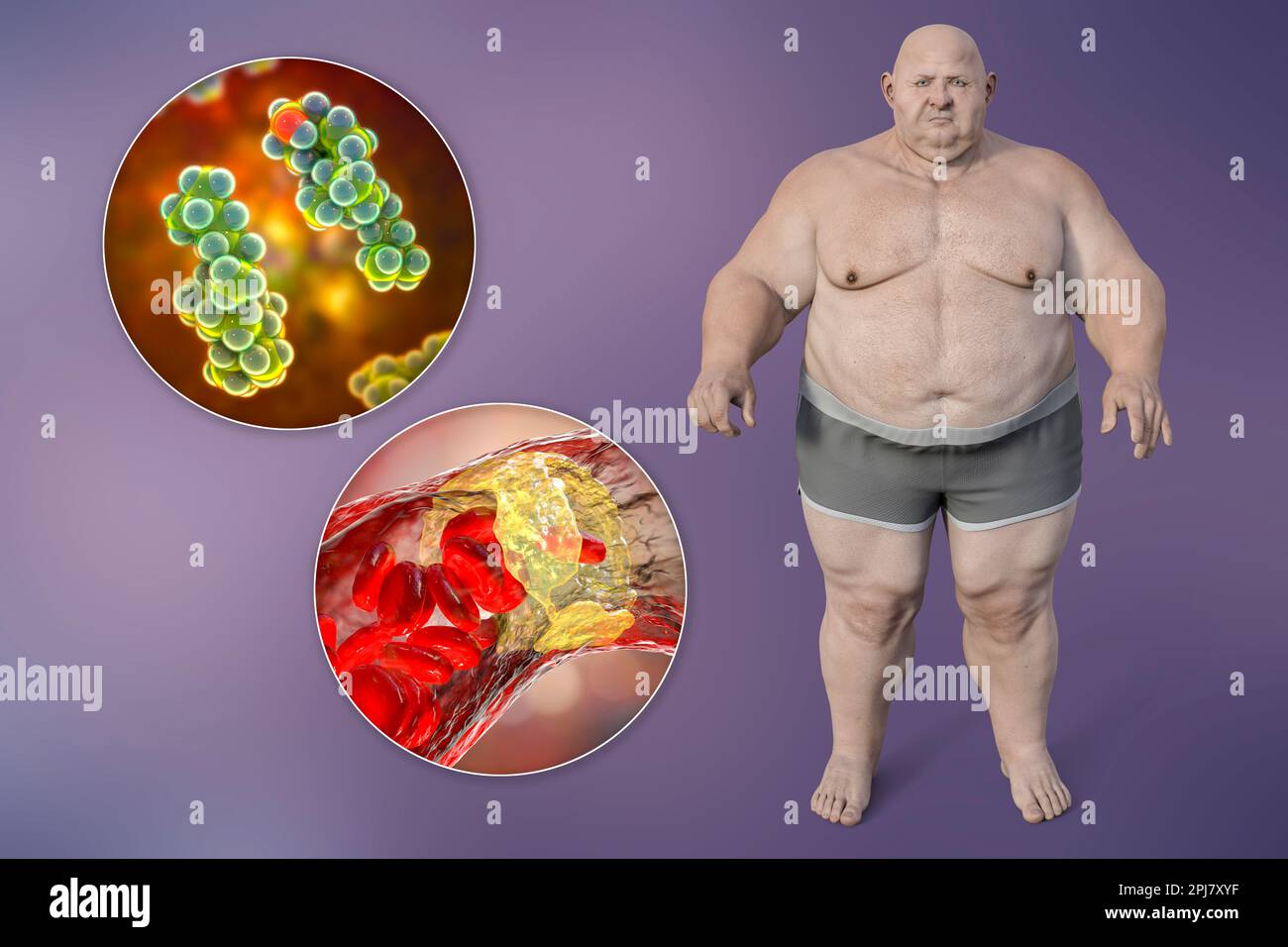 Obésité et athérosclérose, illustration conceptuelle Banque D'Images