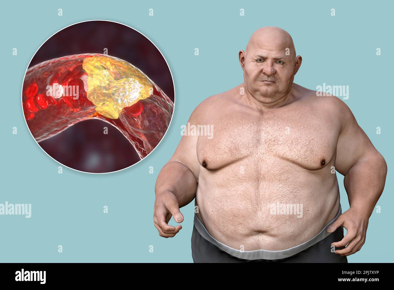 Obésité et athérosclérose, illustration conceptuelle Banque D'Images