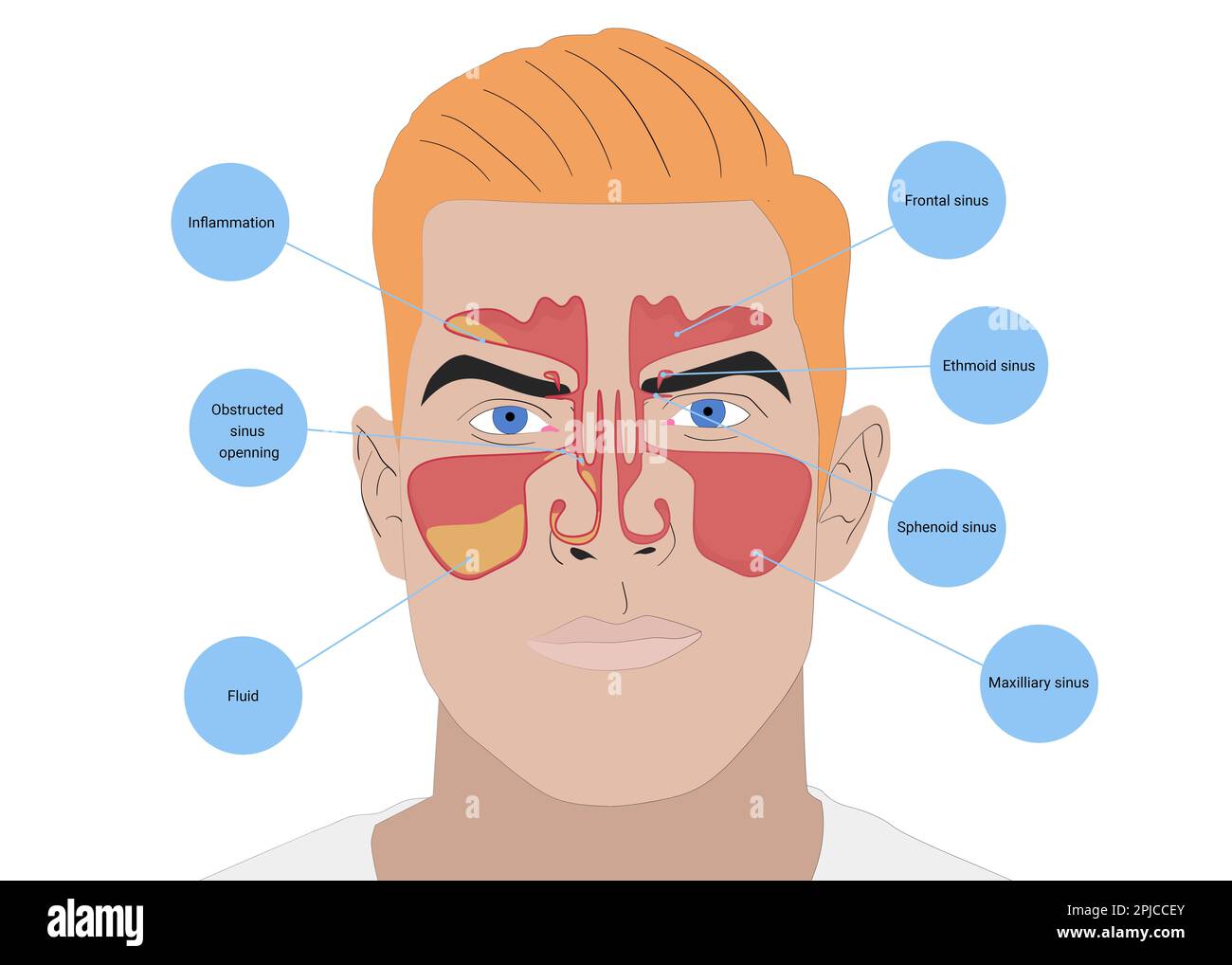 Illustration d'un homme avec des sinus paranasaux sains et inflammatoires sur fond blanc Banque D'Images