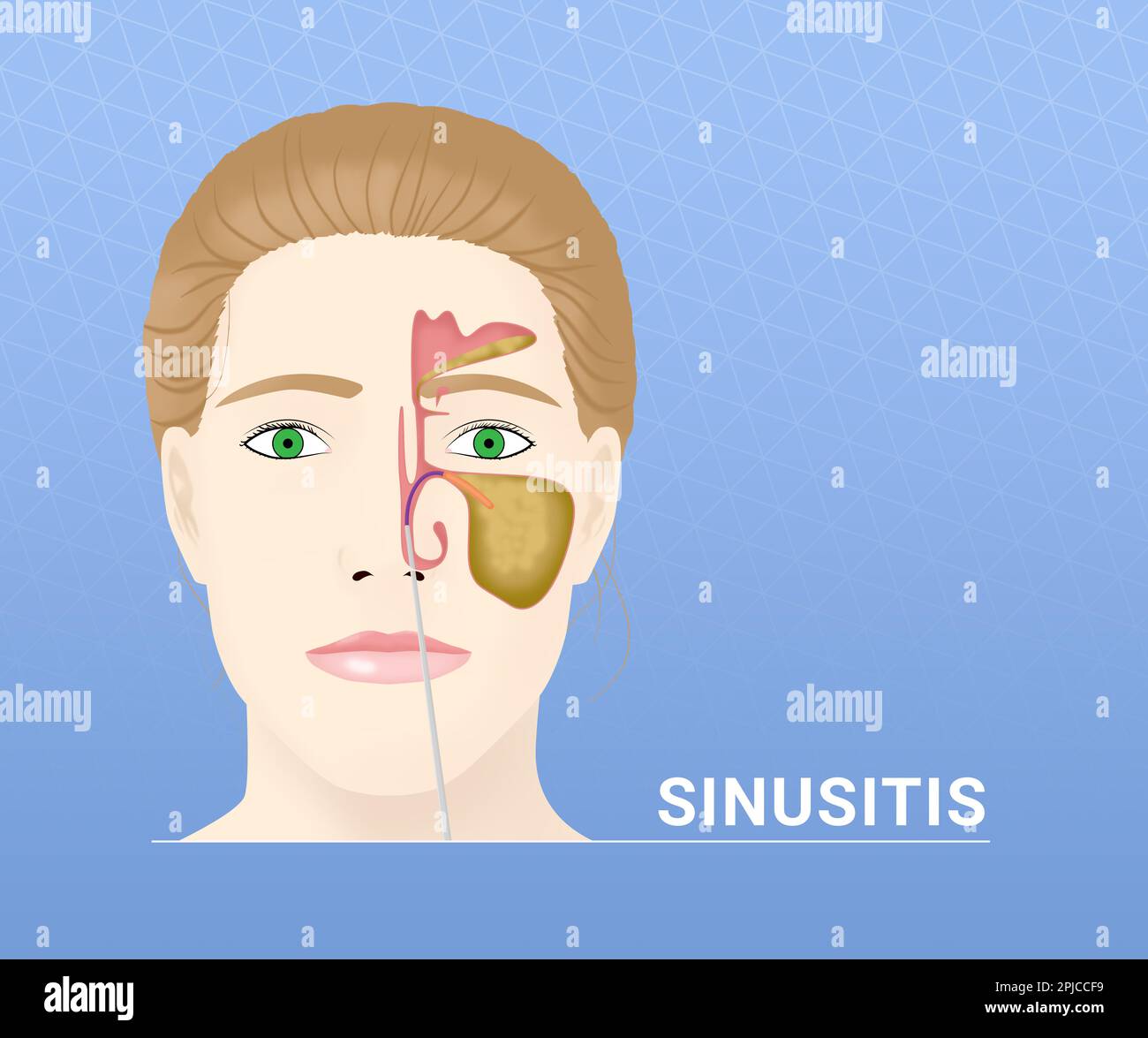 Illustration d'une femme avec sinus enflammé sur fond bleu clair Banque D'Images