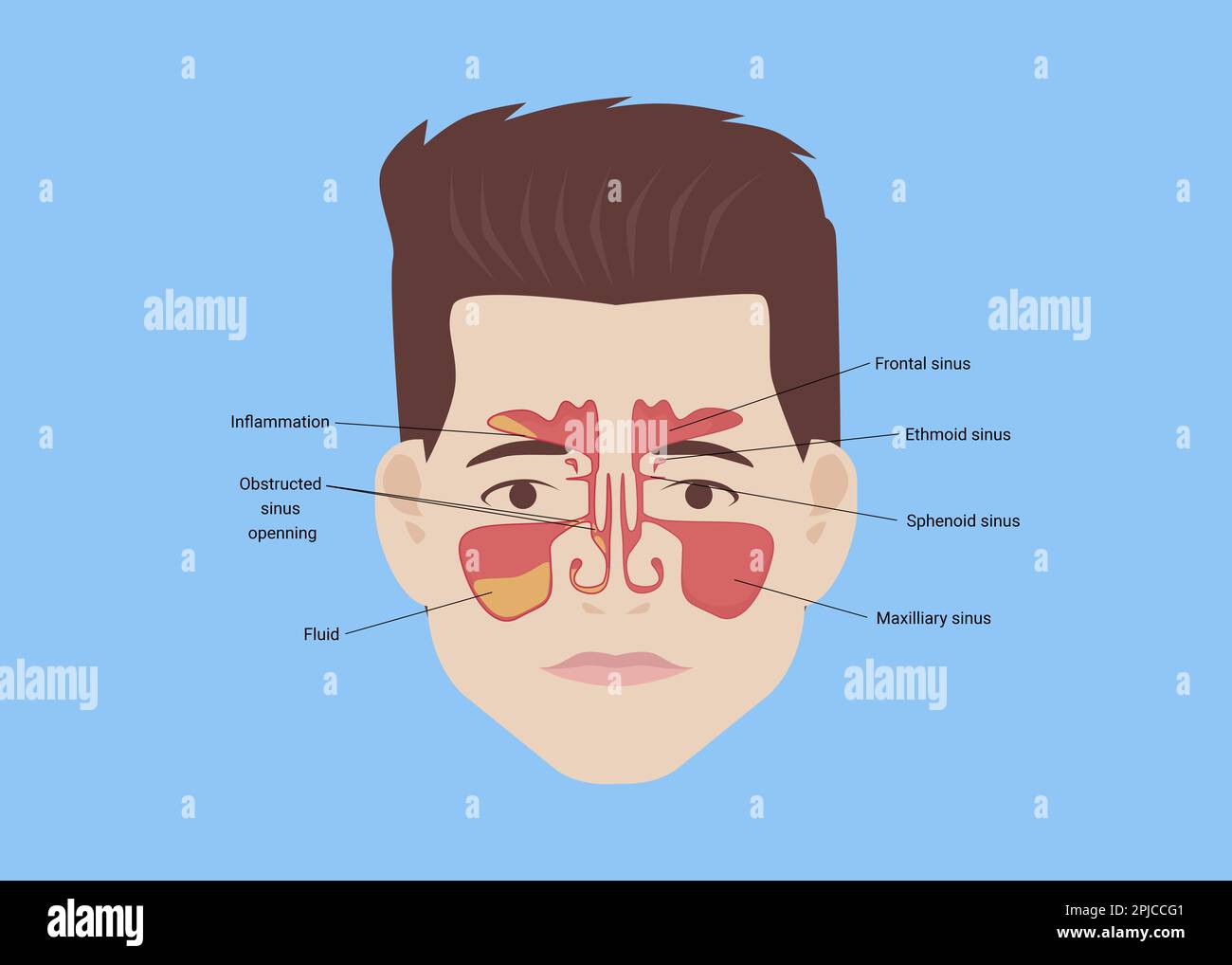 Illustration d'un homme avec des sinus paranasaux sains et inflammatoires sur fond bleu clair Banque D'Images