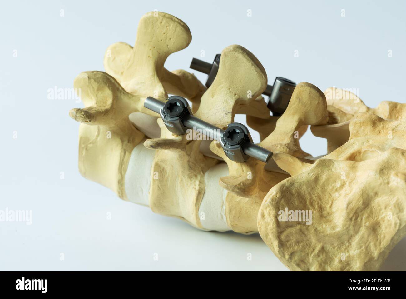 Vue rapprochée de l'instrument fixation du modèle de rachis lombaire sur fond blanc. Banque D'Images