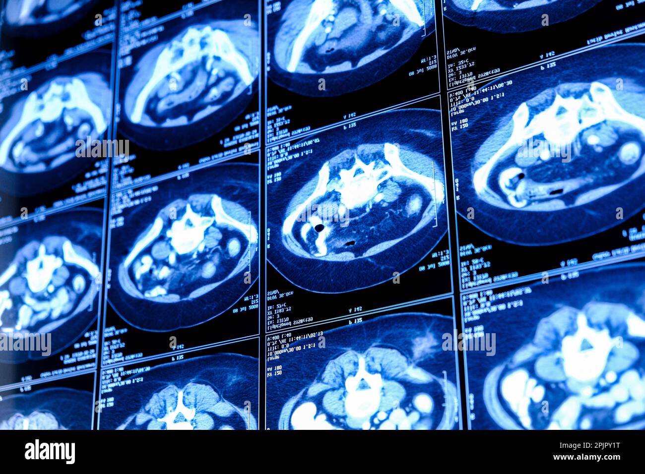 Tomodensitométrie (TDM) du thorax avec l'abdomen Banque D'Images