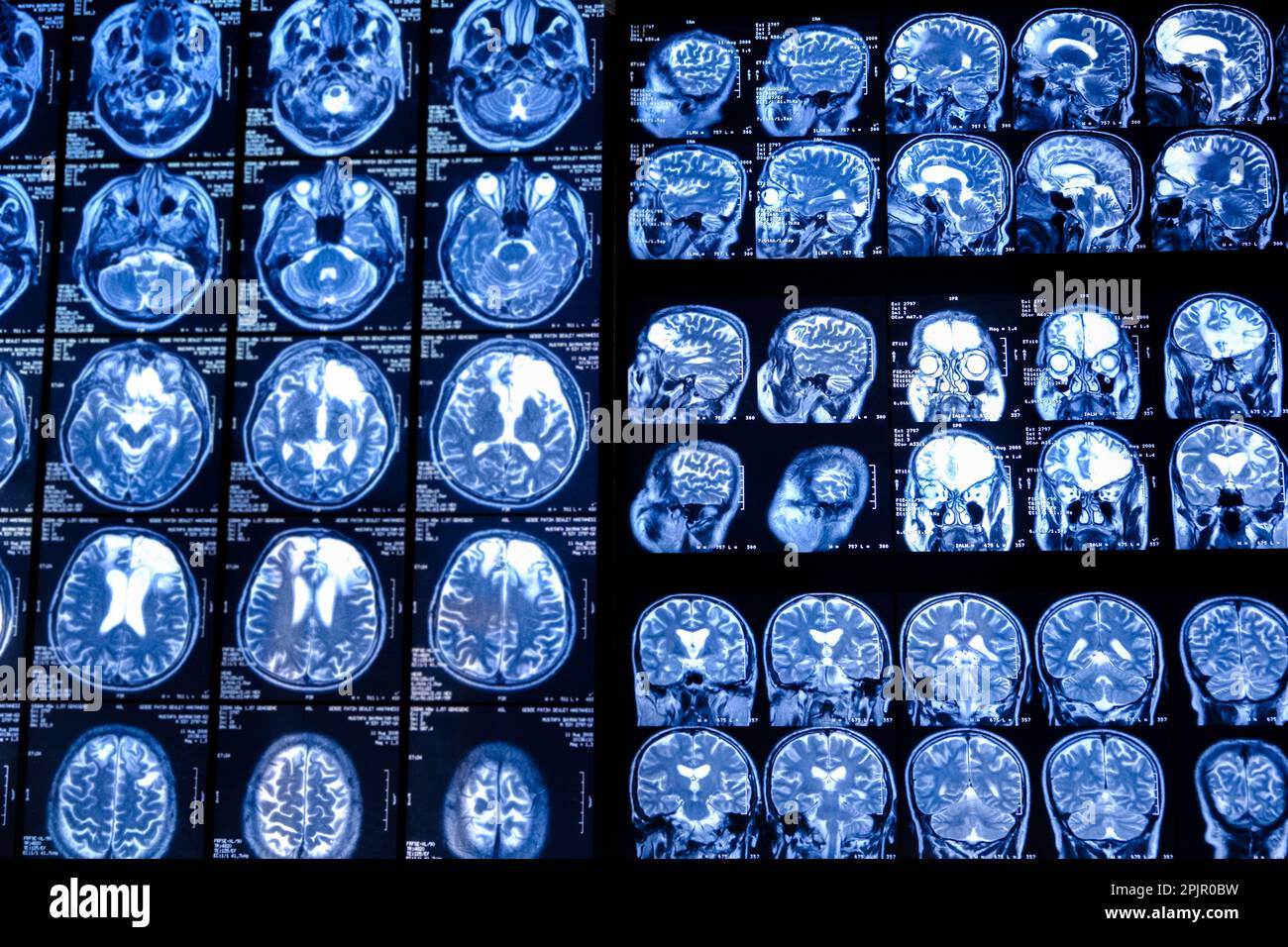 IRM du cerveau pour le diagnostic. Examen médical pour la prévention de la santé. Cliché tomographique. Gros plan d'une acquisition CT avec cerveau. Banque D'Images