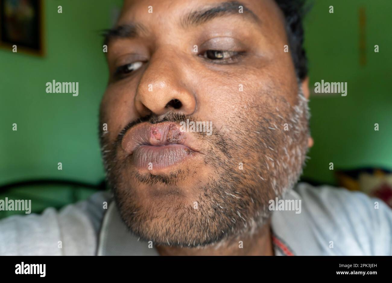 Les lèvres d'un homme d'âge moyen présentaient des ampoules d'herpès. Plaie froide sur la lèvre d'un homme d'âge moyen Banque D'Images Les lèvres d'un homme d'âge moyen présentaient des ampoules d'herpès. Plaie froide sur la lèvre d'un homme d'âge moyen Banque D'Images