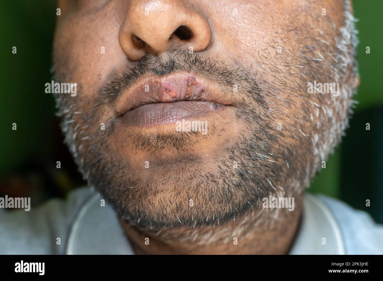 Gros plan sur un virus de l'herpès sur les lèvres des hommes. Une plaie froide sur la lèvre d'un homme d'âge moyen. Ampoules de fièvre Banque D'Images Gros plan sur un virus de l'herpès sur les lèvres des hommes. Une plaie froide sur la lèvre d'un homme d'âge moyen. Ampoules de fièvre Banque D'Images