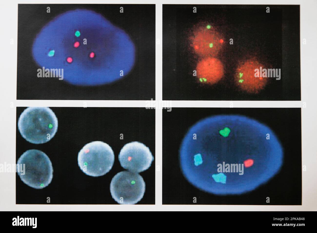Laboratoire de cytogénétique, diagnostic prénatal par imagerie médicale FISH (hybridation fluorescente in situ / hybridation par fluorescence in situ). Banque D'Images