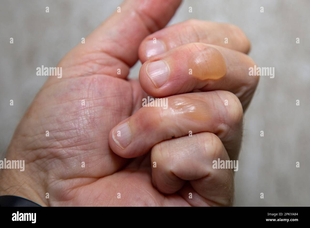 Ampoules typiques de la peau provenant de brûlures d'huile bouillante au deuxième degré. Banque D'Images Ampoules typiques de la peau provenant de brûlures d'huile bouillante au deuxième degré. Banque D'Images