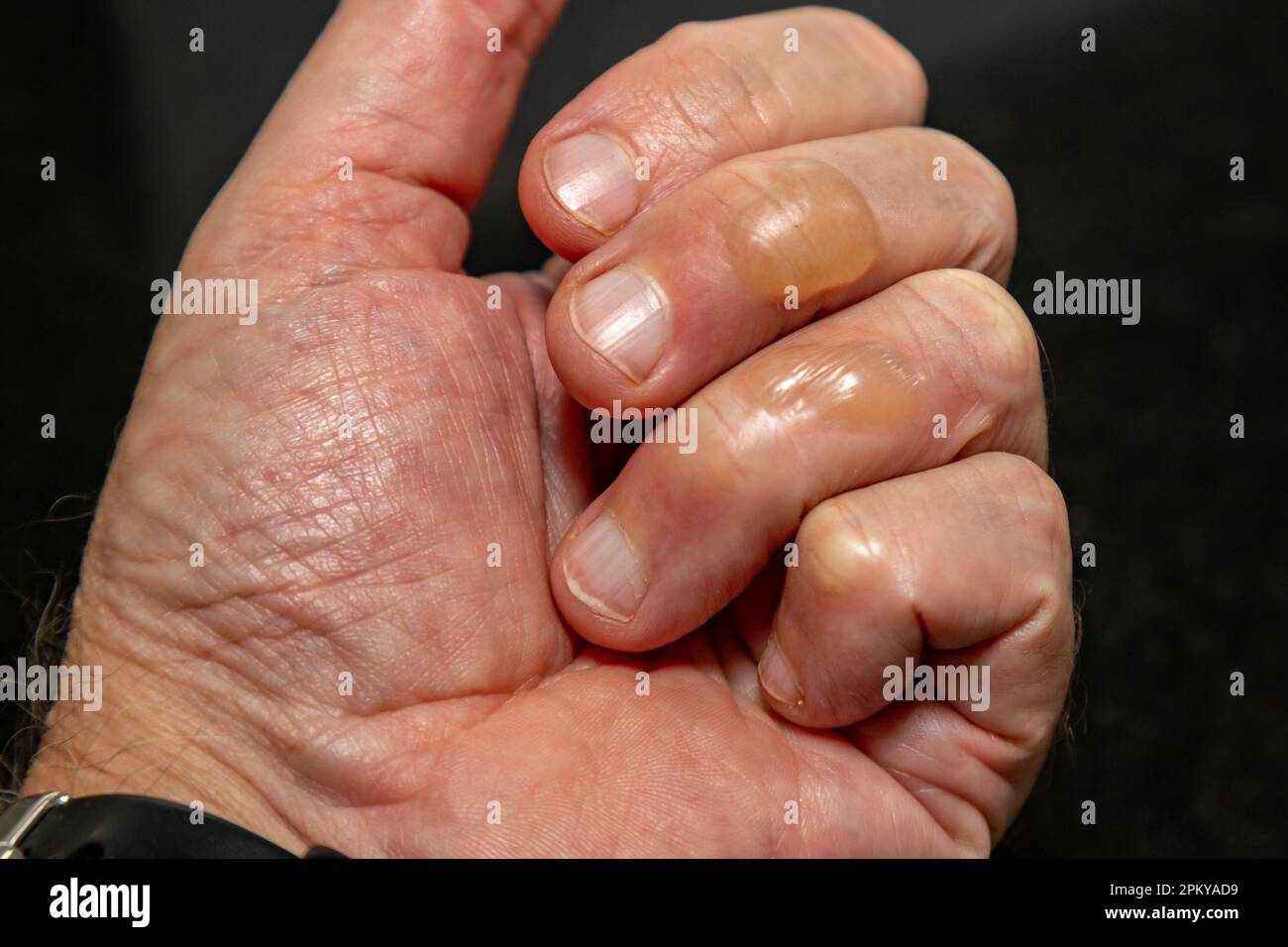 Ampoules typiques de la peau provenant de brûlures d'huile bouillante au deuxième degré. Banque D'Images Ampoules typiques de la peau provenant de brûlures d'huile bouillante au deuxième degré. Banque D'Images