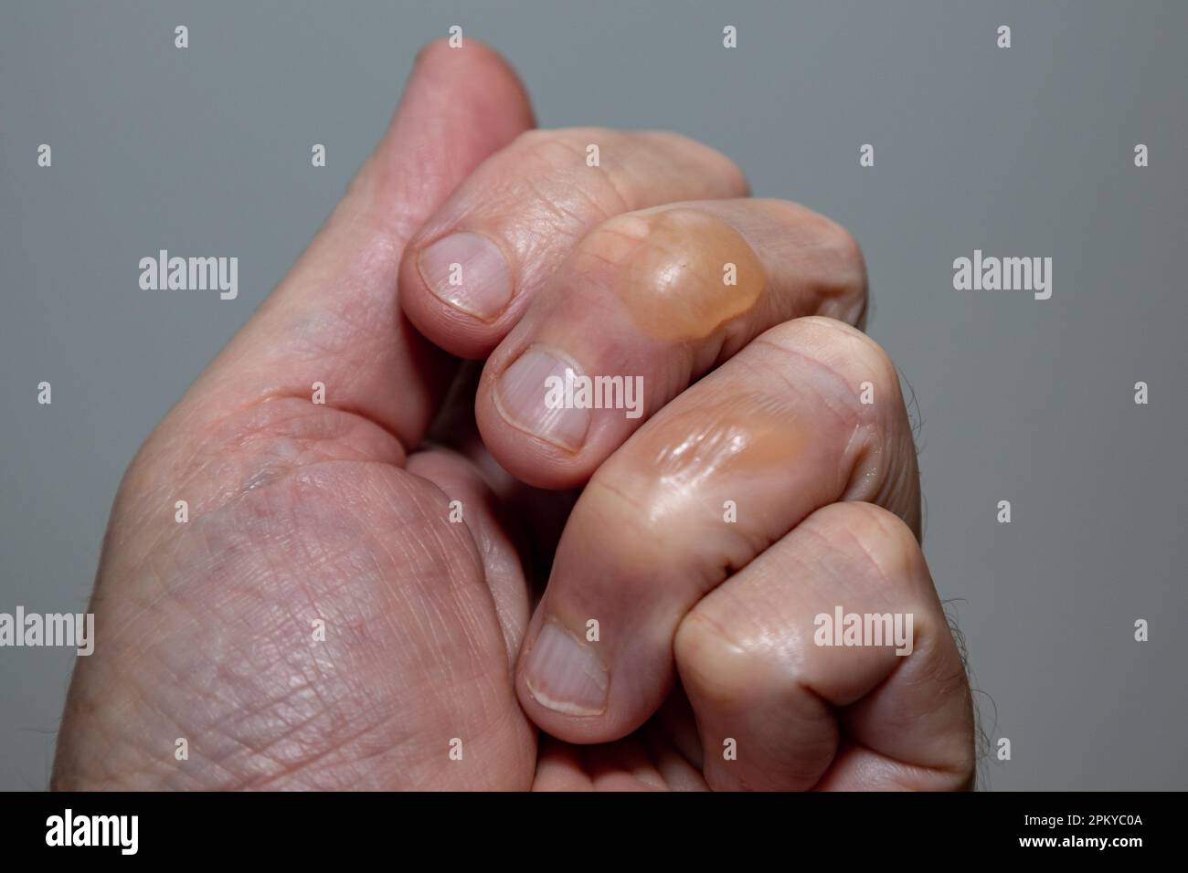 Ampoules typiques de la peau provenant de brûlures d'huile bouillante au deuxième degré. Banque D'Images Ampoules typiques de la peau provenant de brûlures d'huile bouillante au deuxième degré. Banque D'Images