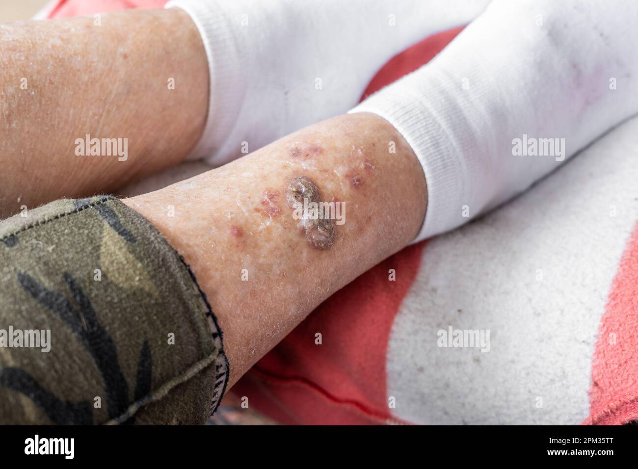 Ulcères et maladies de la peau, croûtes séchées et blessures fraîches sur les jambes d