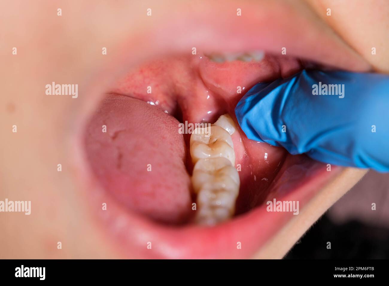 Les dents de sagesse affectent et causent la récession gingivale. Banque D'Images