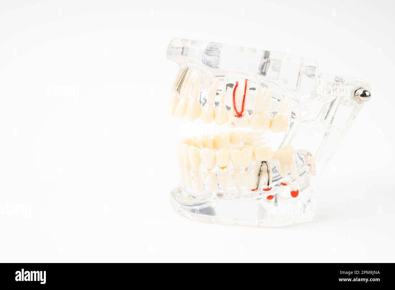 Les prothèses dentaires, les dents et les prothèses humaines sur fond blanc. Banque D'Images