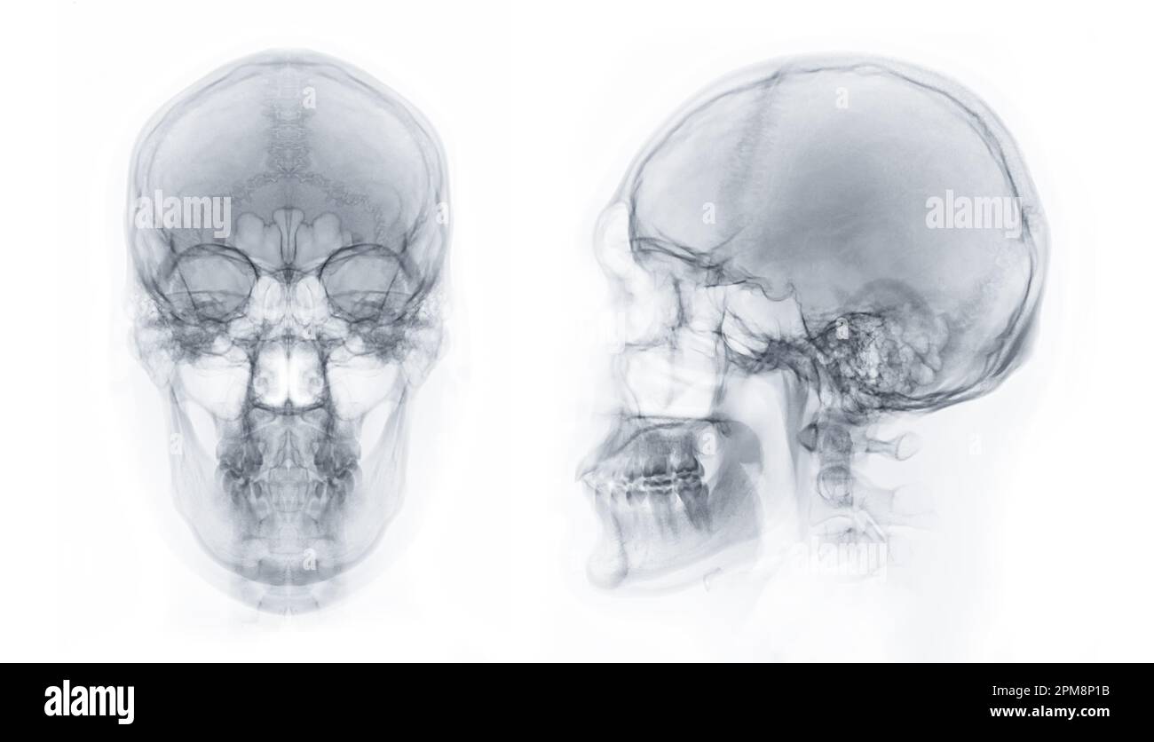 Image radiographique du crâne humain vue AP et latérale pour le diagnostic de fracture du crâne isolée sur fond noir. Banque D'Images
