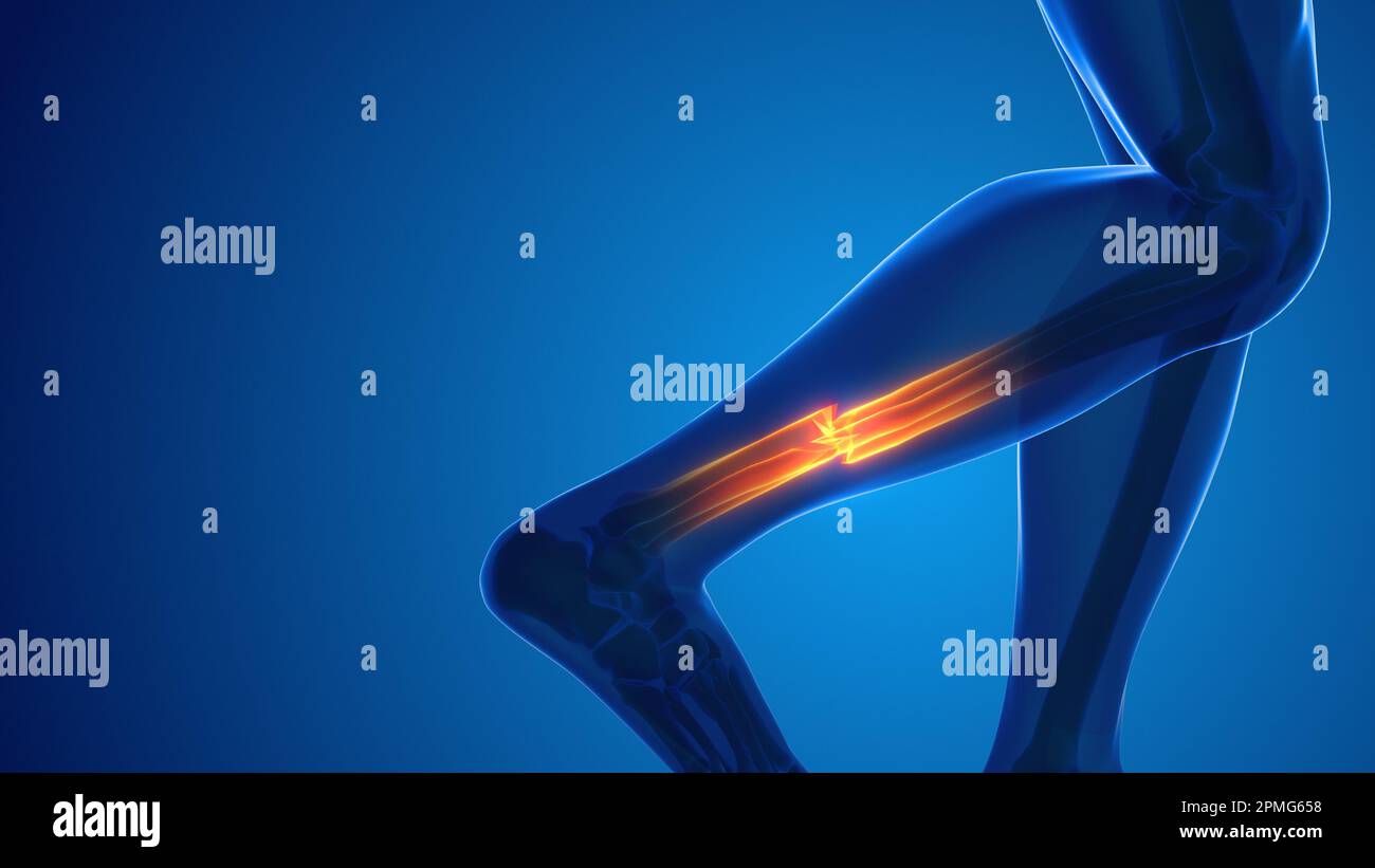 Douleur osseuse de jambe cassée concept médical Banque D'Images