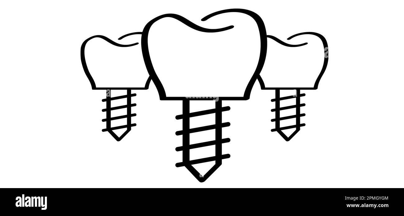 Implant dentaire, médicalement précis ou pont dentaire. Dessin animé sain, dent avec des gencives. Motif de ligne molaire. Dessin de la dent avec la vis. Dents endommagées ou Banque D'Images