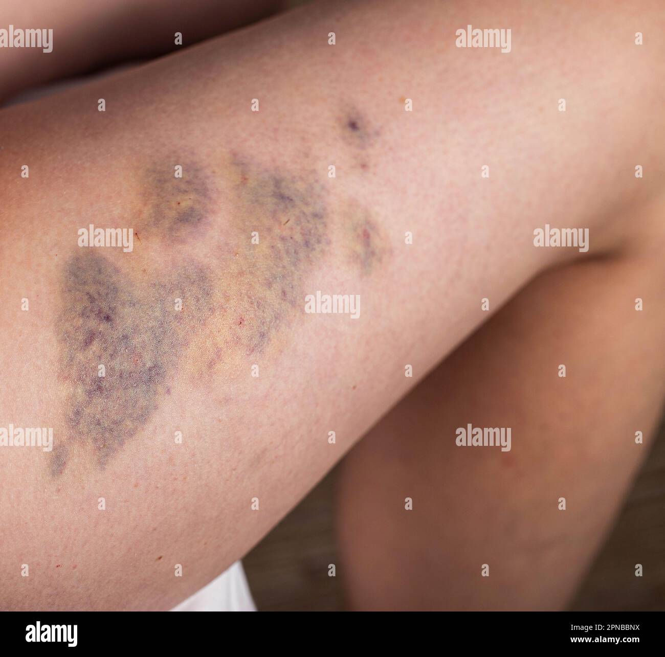 Ecchymoses sur la jambe d'une patiente après un massage thérapeutique, gros plan. Hématome Banque D'Images