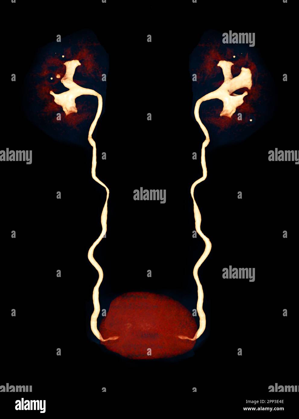 CTA image de rendu de l'artère rénale 3D montrant les deux reins, l'uretère et la vessie . Banque D'Images