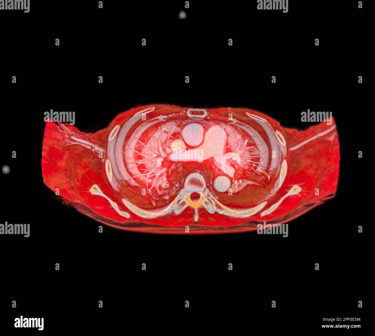 CTA artères pulmonaires 3D rendu montrant la branche de l'artère pulmonaire Banque D'Images