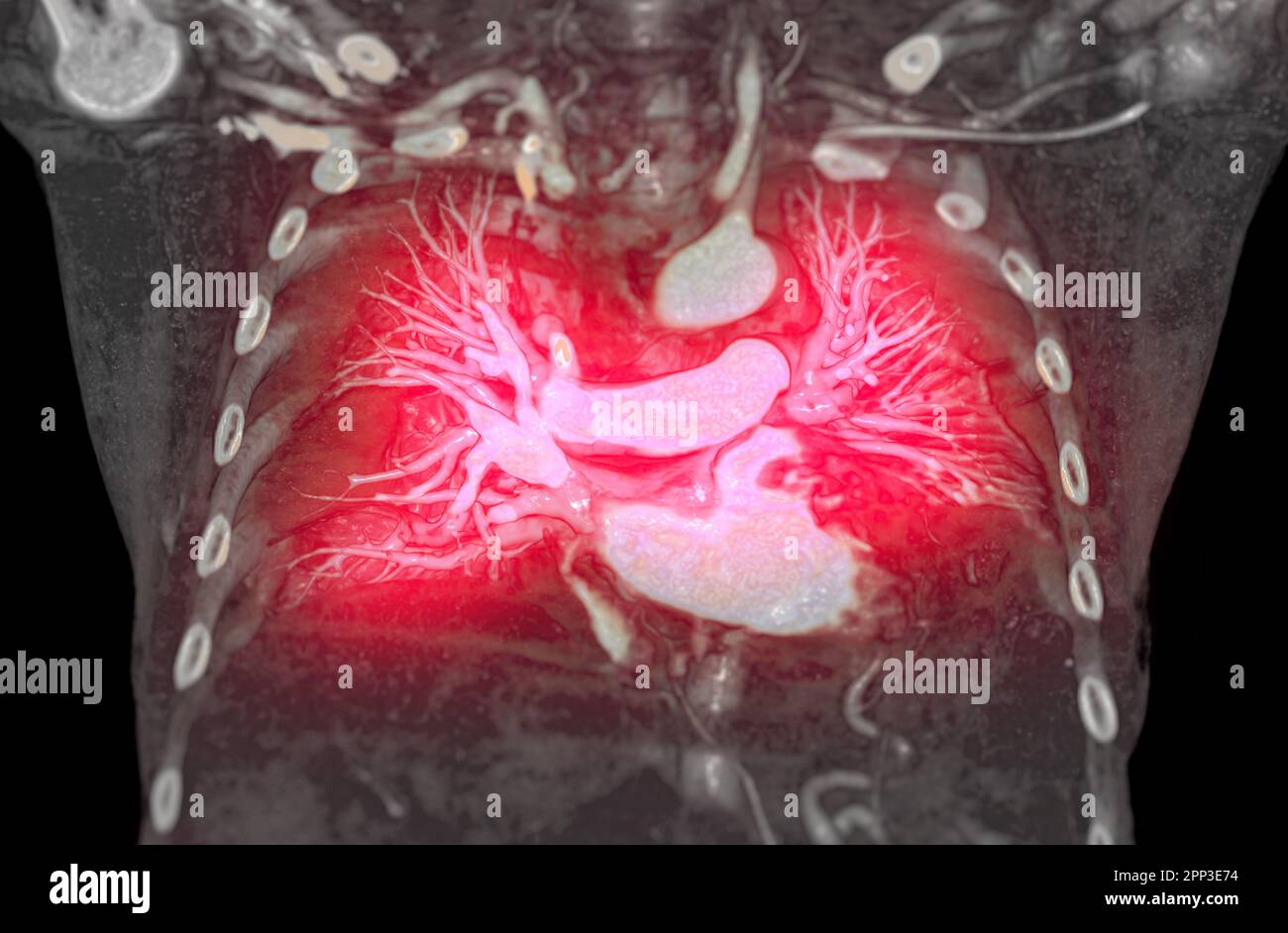 CTA artères pulmonaires 3D rendu montrant la branche de l'artère pulmonaire Banque D'Images