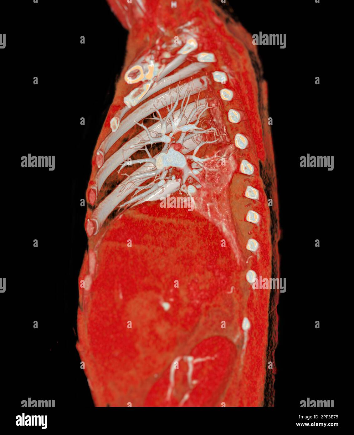 CTA artères pulmonaires 3D rendu montrant la branche de l'artère pulmonaire Banque D'Images