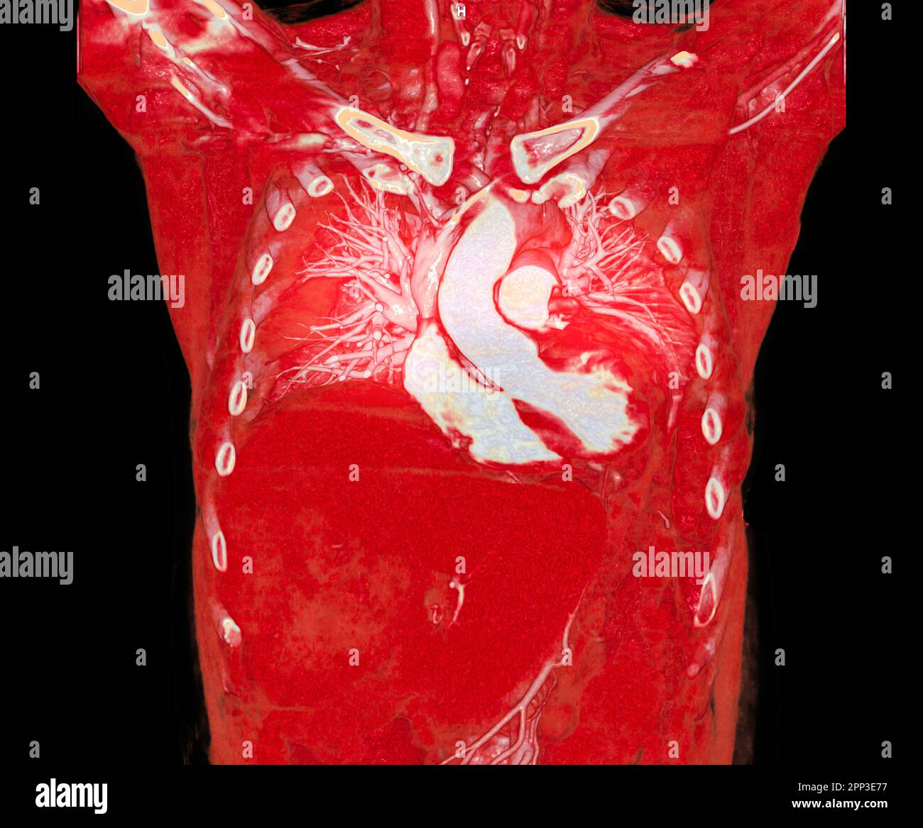 CTA artères pulmonaires 3D rendu montrant la branche de l'artère pulmonaire Banque D'Images