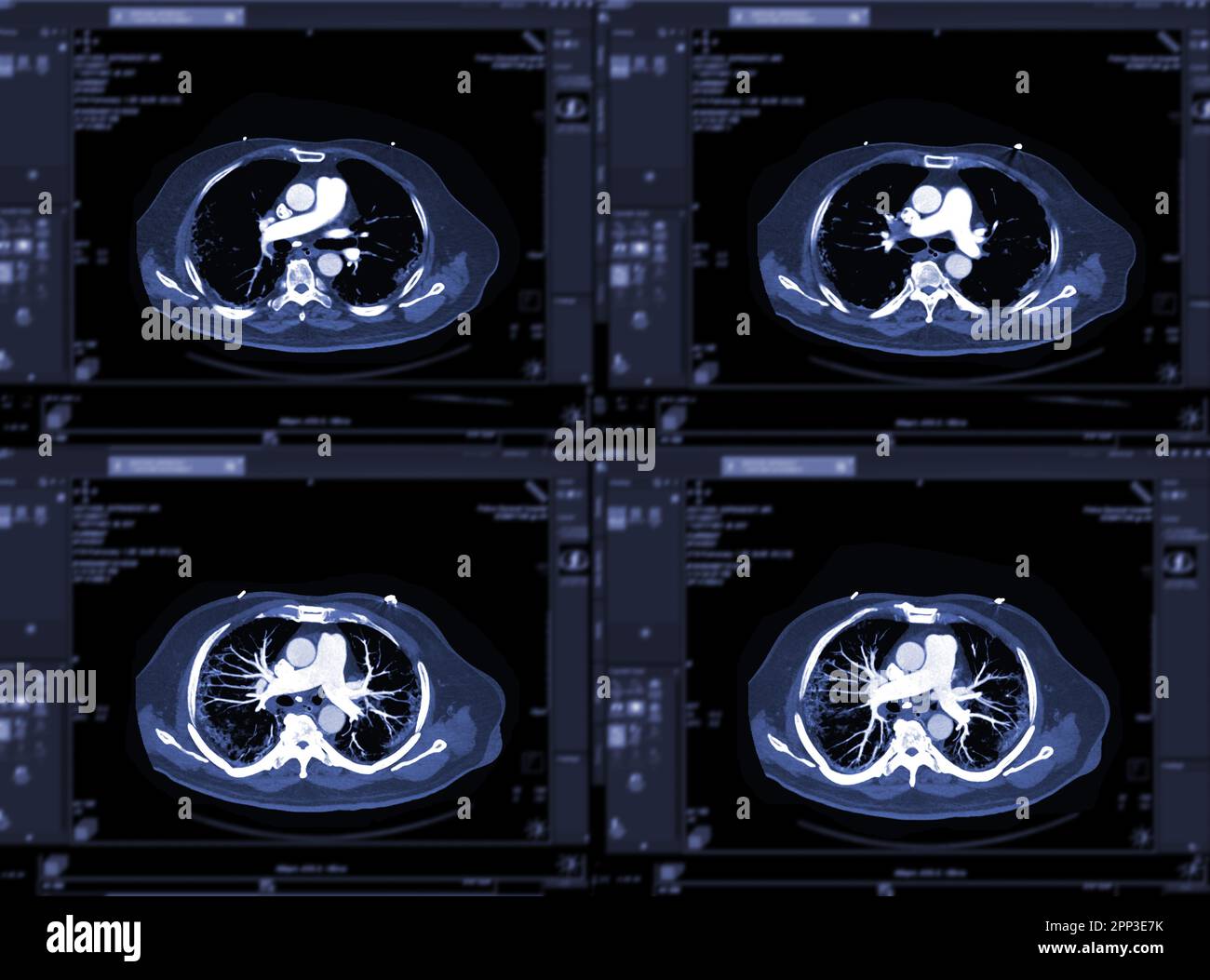 CTA artères pulmonaires 3D rendu montrant la branche de l'artère pulmonaire Banque D'Images