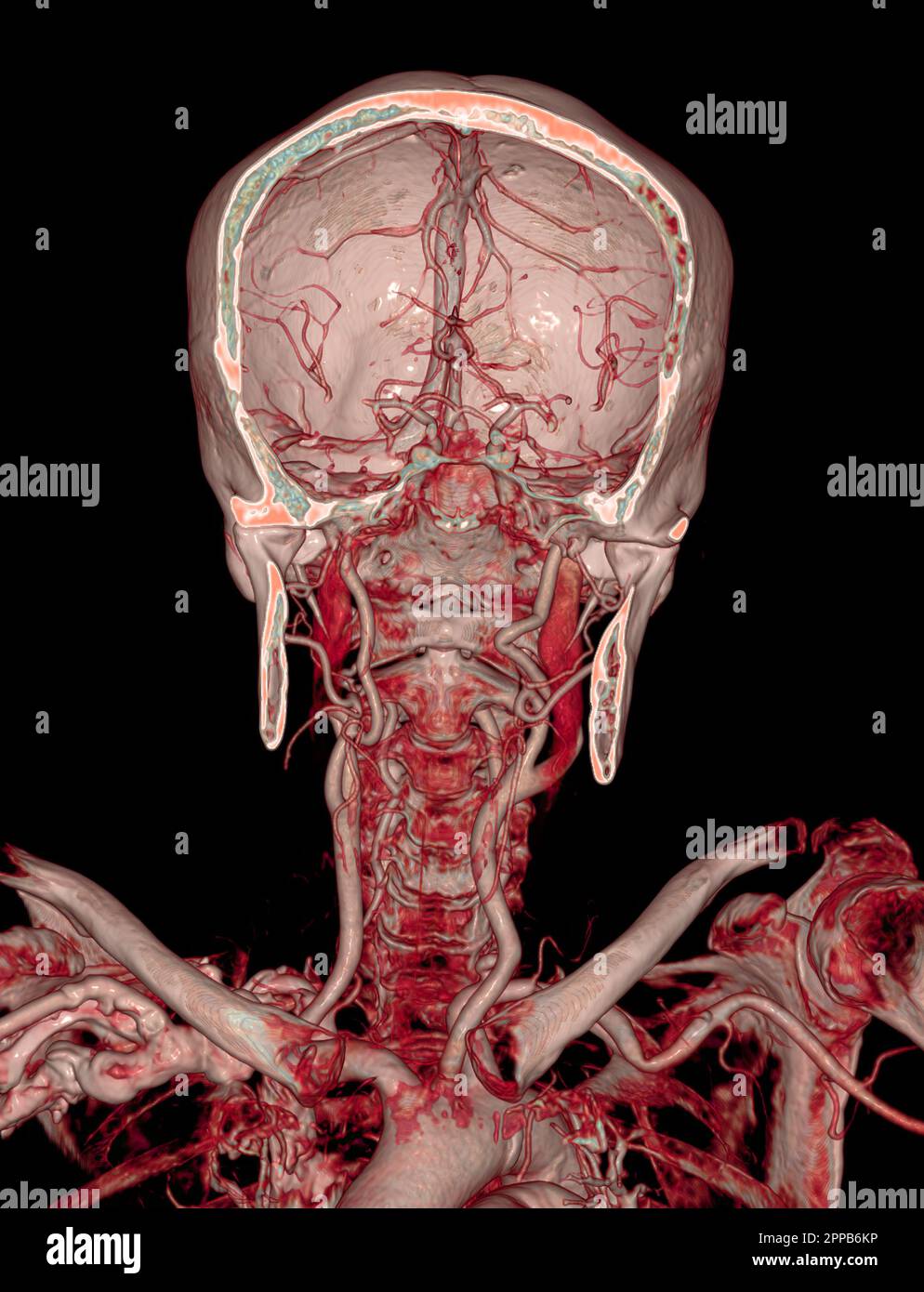 CTA cerveau et artère carotide ou angiographie CT du cerveau 3D rendu ...