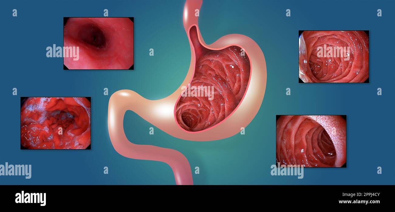 Muqueuse gastrique. Endoscopie digestive ou gastroscopie. Réalisation d'une procédure de gastroscopie. Diagnostic des maladies gastriques. La santé de l'estomac. Banque D'Images