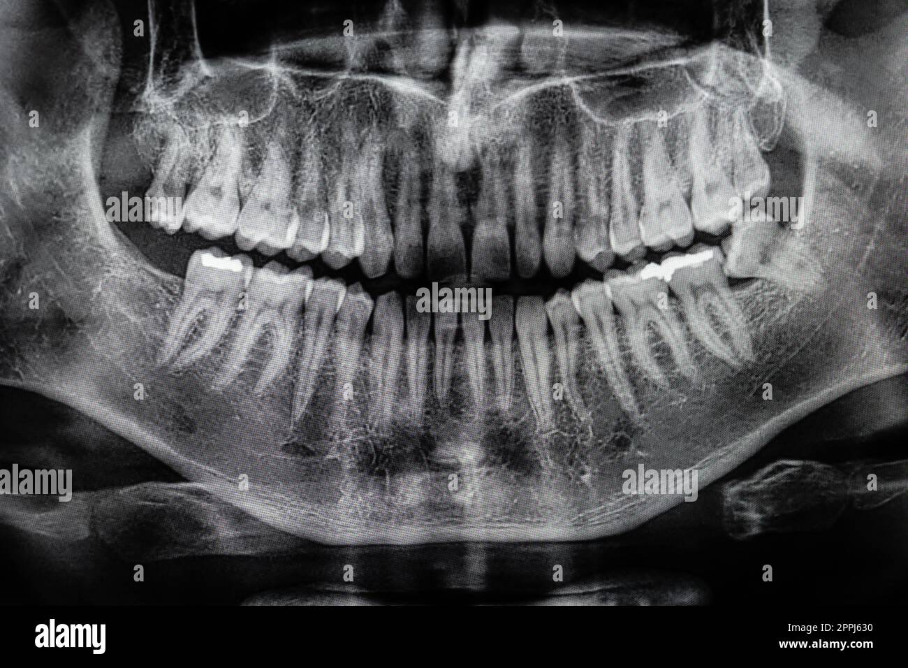Orthopantomographie, OPG rayons X DR dents de sagesse numérique. film panoramique radiographie dentaire Banque D'Images