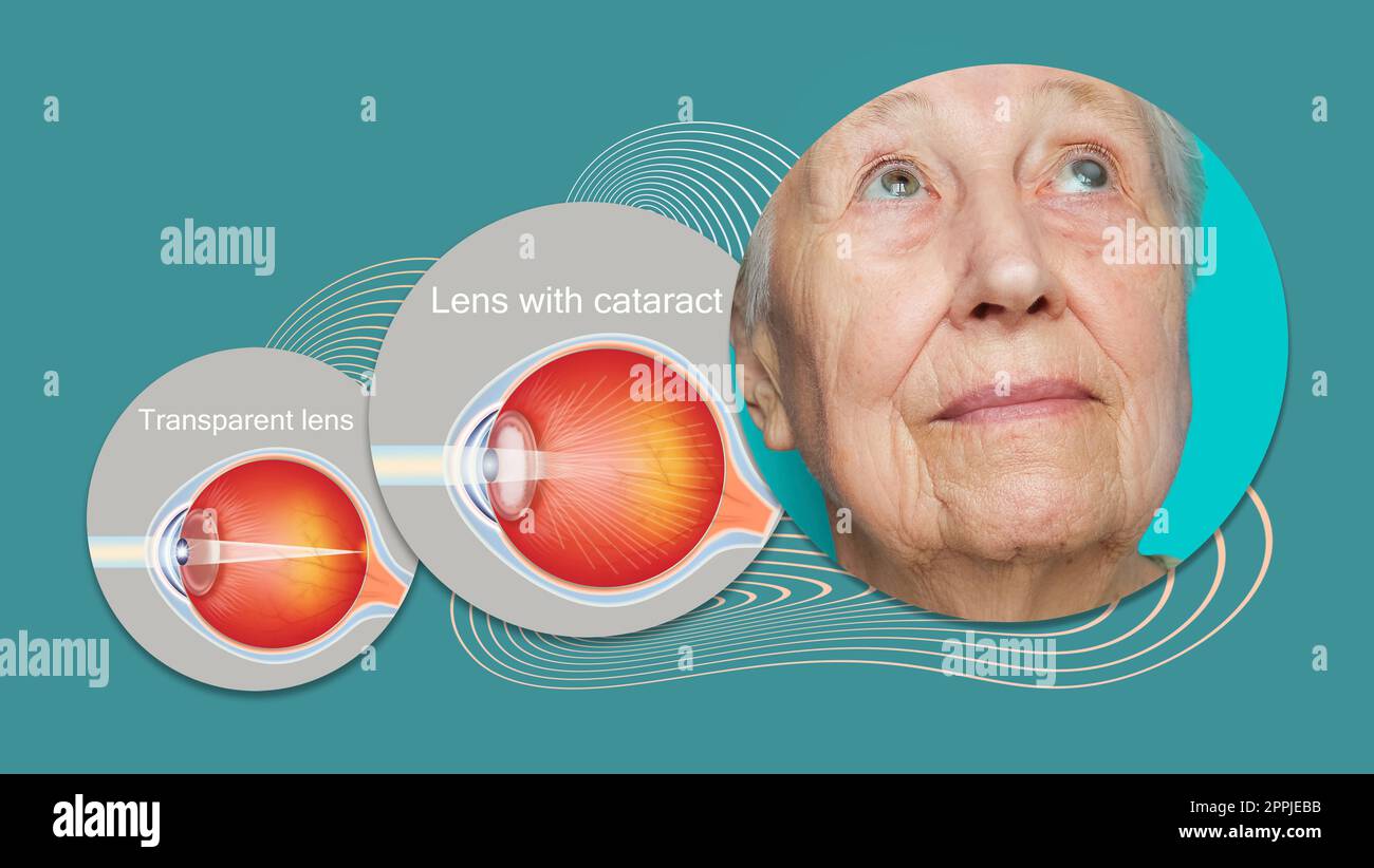 Concept de cataracte. Œil de femme senior, gros plan Banque D'Images