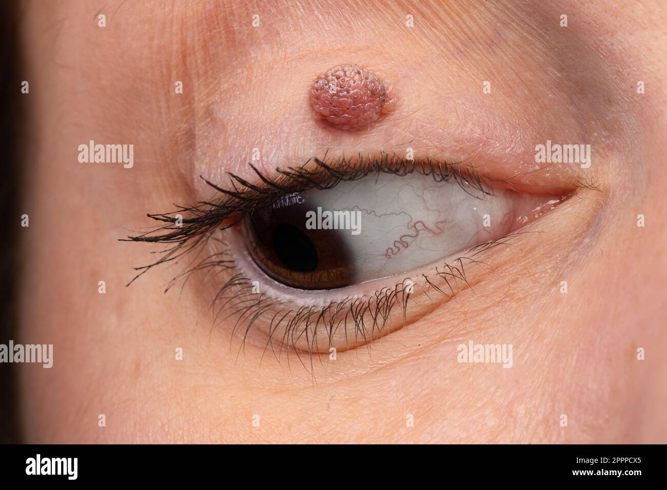 Un oeil de femme avec un nevus mélanocytique de paupière. Kyste de kératine sur la paupière, une masse semblable à un pailloome. Banque D'Images