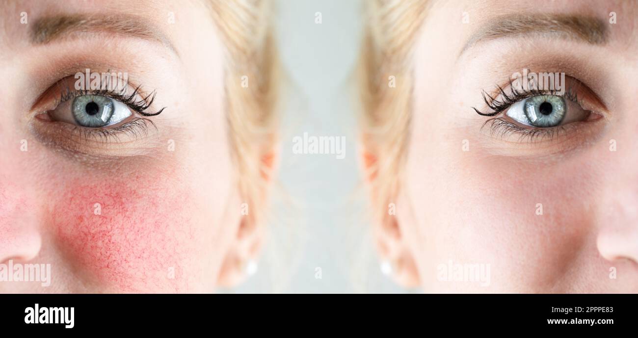 Avant et après le traitement réussi de la rosacée sur le visage d'une femme  caucasienne. La rougeur et les vaisseaux sanguins visibles sont tous  éliminés par chirurgie au laser Photo Stock -