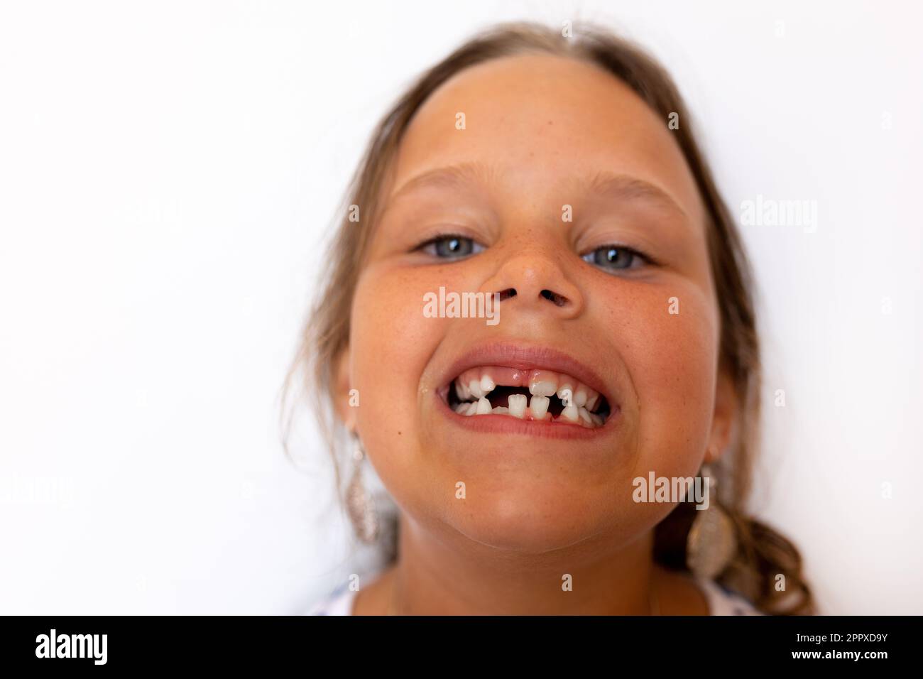 Petite fille mignonne avec une bouche ouverte sans dents et des dents temporaires d'espacement du lait. Carie carie, soins orthodontiques et hygiène Banque D'Images
