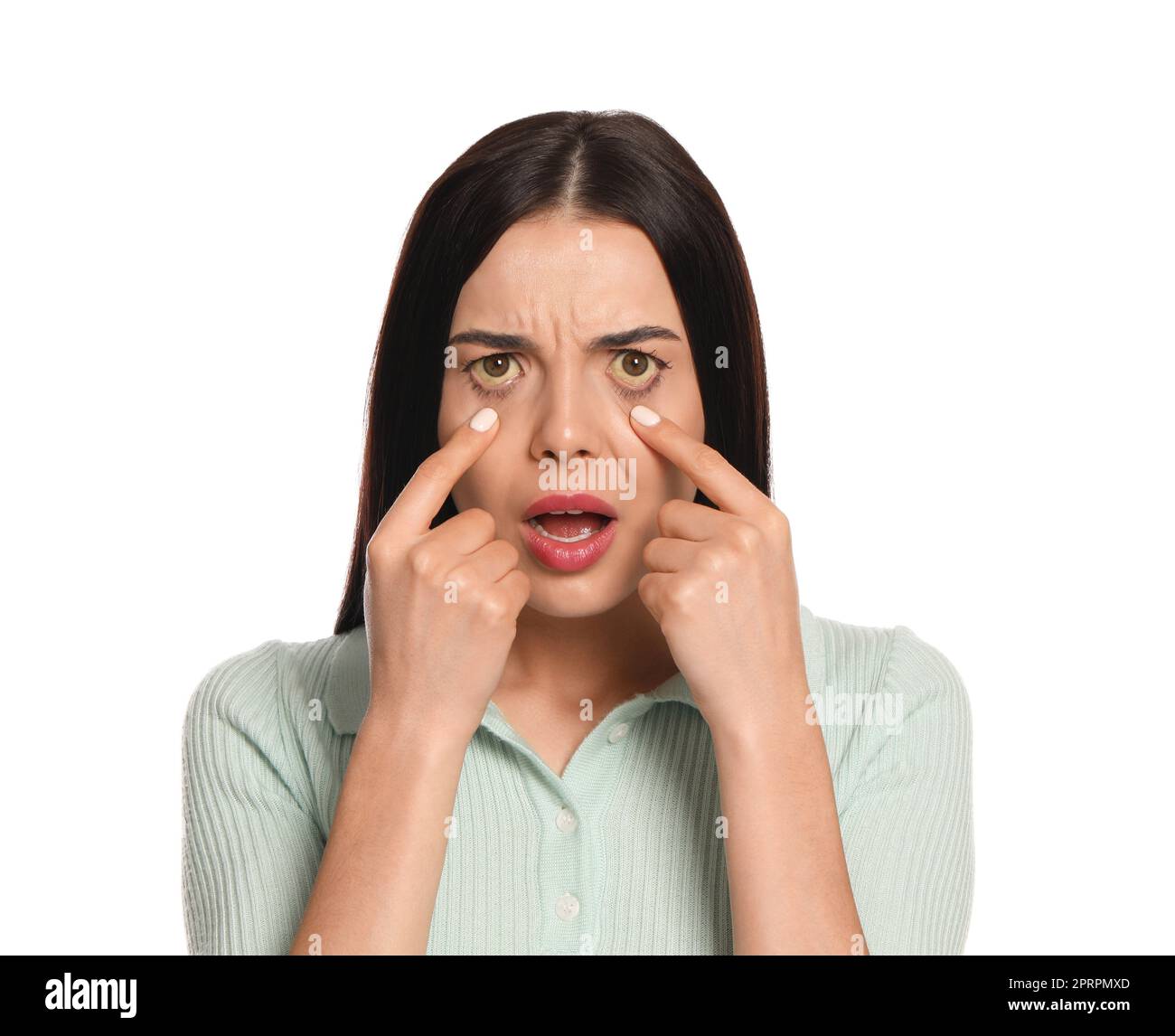 Femme vérifiant son état de santé sur fond blanc. Yeux jaunes comme symptôme de problèmes avec le foie Banque D'Images