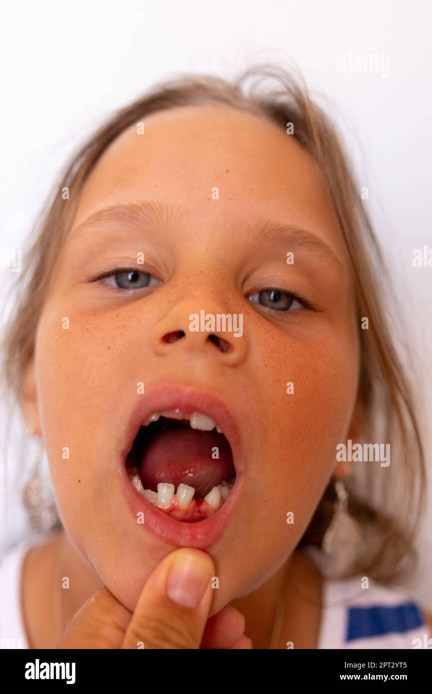 Dentiste main tenir la bouche ouverte de fille sans dents avec des saignements de plaie frais, extraction de dent. Soins orthodontiques et dentaires Banque D'Images