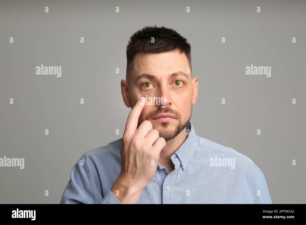 Homme vérifiant son état de santé sur fond gris. Yeux jaunes comme symptôme de problèmes avec le foie Banque D'Images