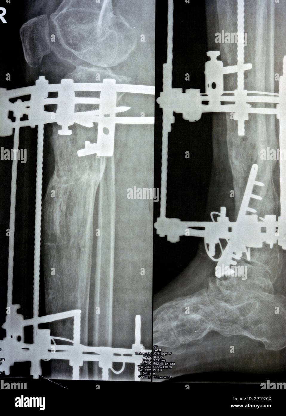 Péroné distal de fracture comminée géré par plaque et vis, tibia distal géré par fixateur d'anneau externe ILIZAROV cadre avec sclérotique resect Banque D'Images