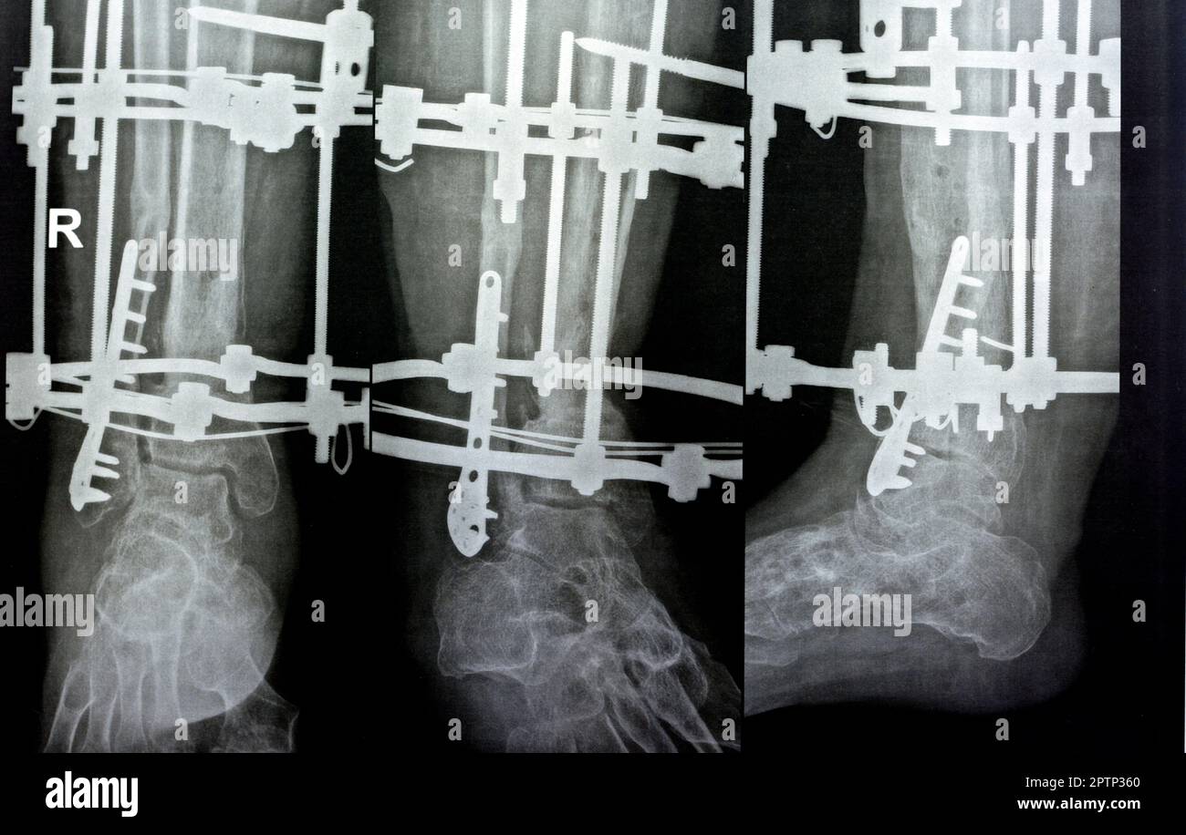 Péroné distal de fracture comminée géré par plaque et vis, tibia distal géré par fixateur d'anneau externe ILIZAROV cadre avec sclérotique resect Banque D'Images