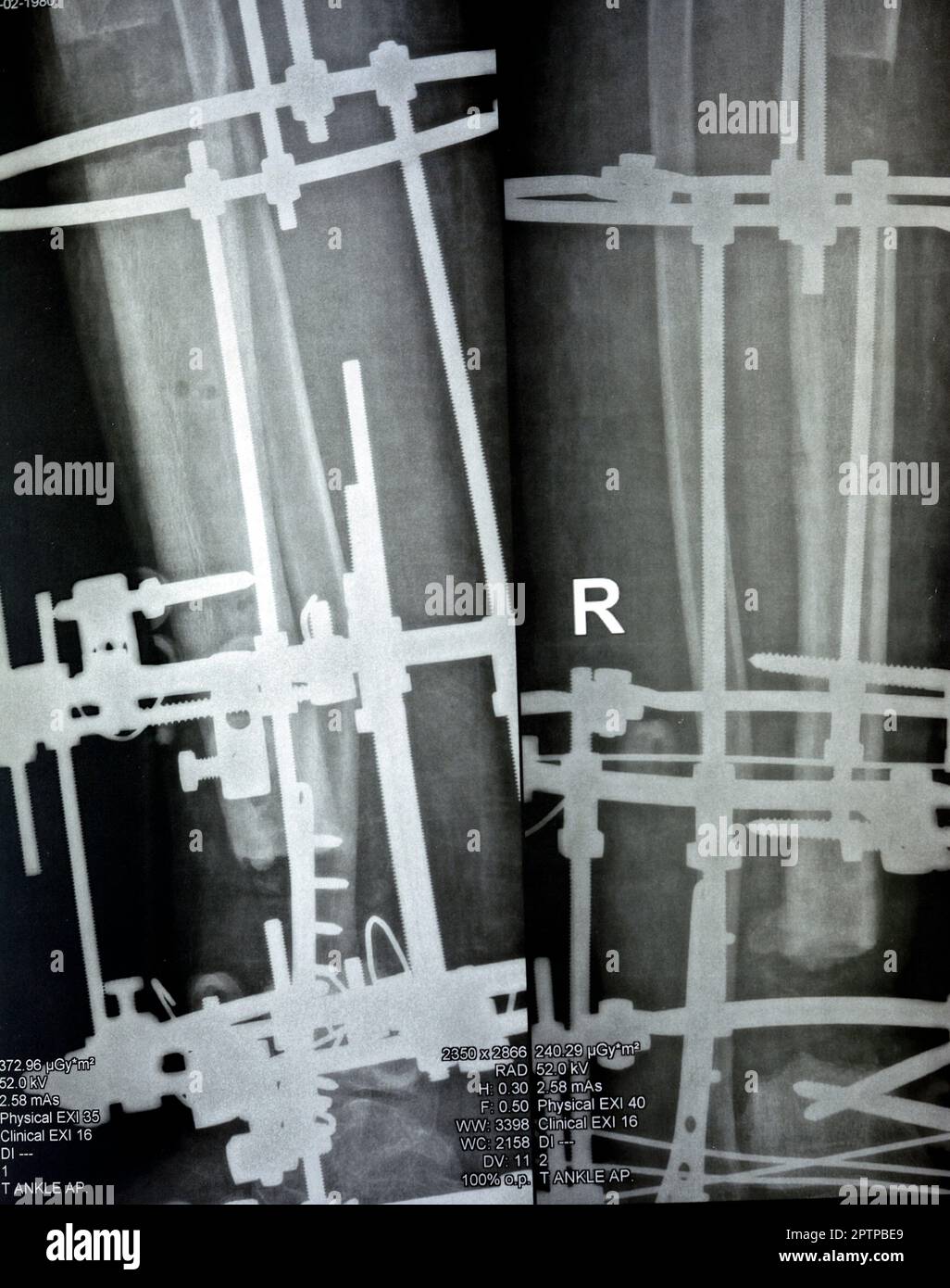 Péroné distal de fracture comminée géré par plaque et vis, tibia distal géré par fixateur d'anneau externe ILIZAROV cadre avec sclérotique resect Banque D'Images