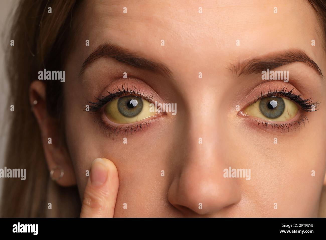 Femme vérifiant son état de santé, gros plan. Yeux jaunes comme symptôme de problèmes avec le foie Banque D'Images