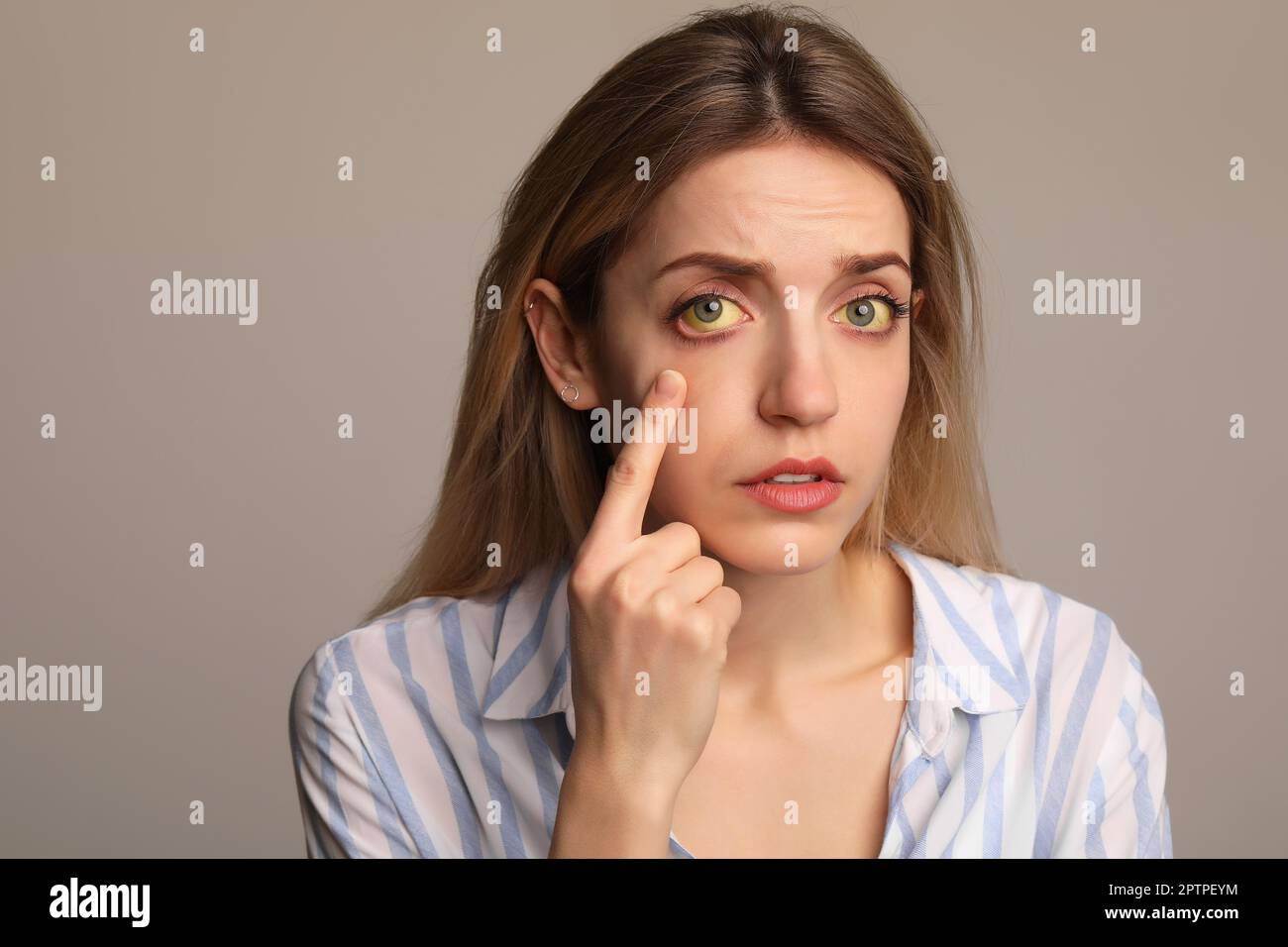 Femme vérifiant son état de santé sur fond gris. Yeux jaunes comme symptôme de problèmes avec le foie Banque D'Images
