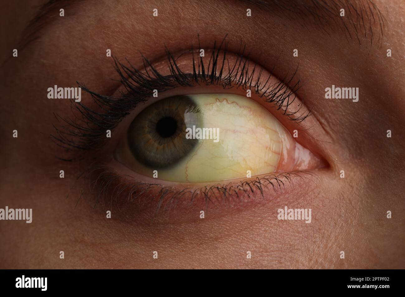 Femme aux yeux jaunes, gros plan. Symptômes des problèmes hépatiques Banque D'Images